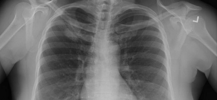 Röntgenfoto via Pulmonary Pathology