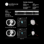 Aidence: detectie van longnodules met kunstmatige intelligentie