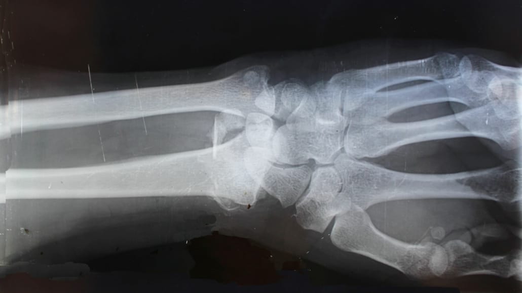 Fractuur