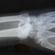 Fractuur